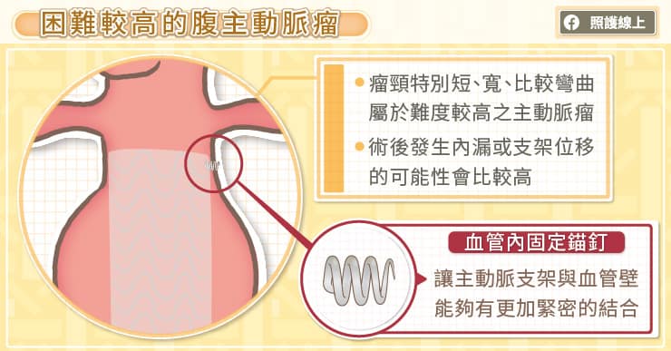 對付困難腹主動脈瘤，血管內固定錨釘很關鍵，心臟血管外科主任圖解說明