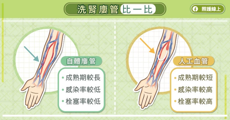 留意警訊，及時搶通洗腎廔管，血管外科醫師圖解懶人包
