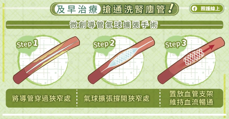 留意警訊，及時搶通洗腎廔管，血管外科醫師圖解懶人包