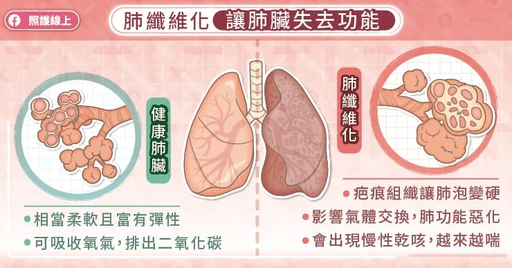 紅斑性狼瘡傷心、傷腎、又傷肺，慢性咳嗽當心肺纖維化-自體免疫疾病