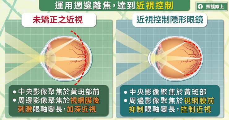 破解迷思！兒童近視要積極控制，專用日拋、角膜塑型片、散瞳藥水比一比，眼科醫師圖文解析-日拋隱形眼鏡
