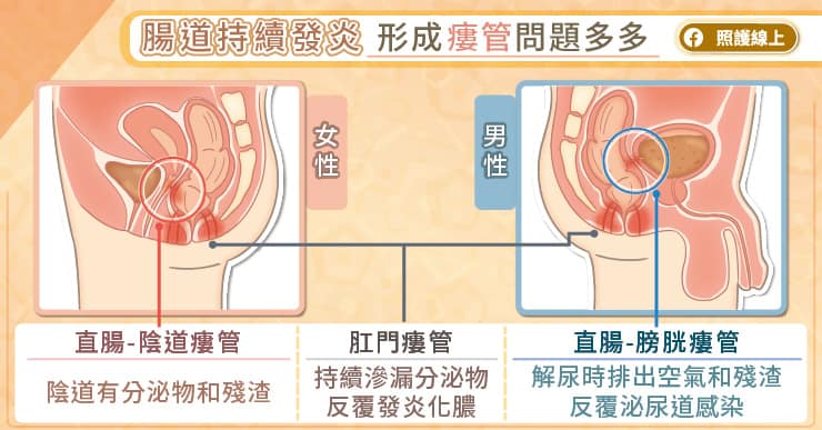 放任腸道發炎，癌症提早上身，穩定治療潰瘍性大腸炎｜醫師圖文解說-三軍總醫院