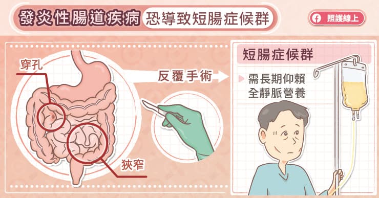 發炎性腸道疾病怎麼辦？生物製劑幫助黏膜癒合，避免動刀切腸子，醫師圖文詳解-5-ASA抗發炎藥物
