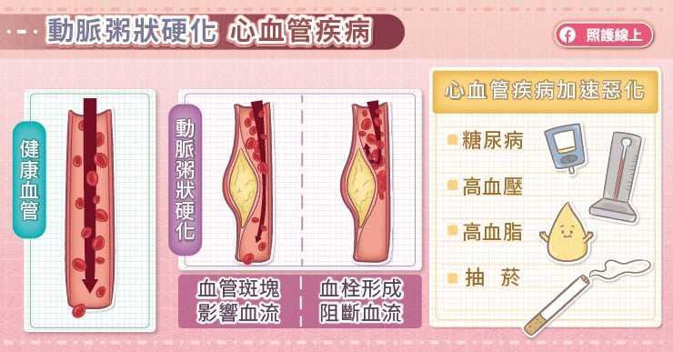 預防動脈粥狀硬化！糖尿病專家：只要這指數控制好，就是最強防護-林口長庚醫院