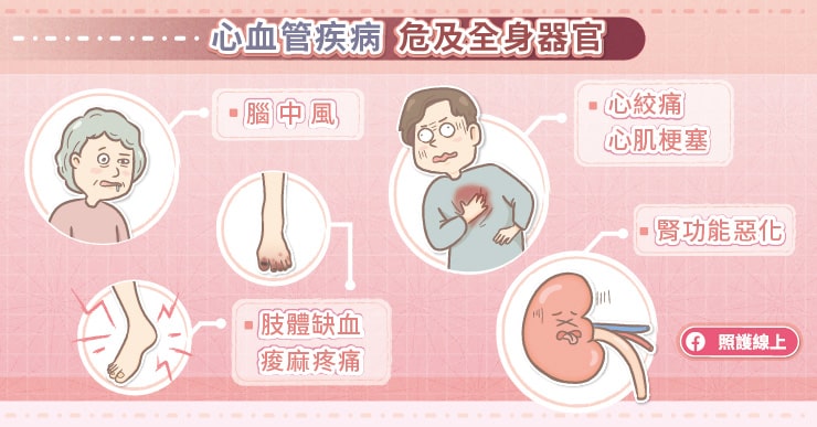 預防動脈粥狀硬化！糖尿病專家：只要這指數控制好，就是最強防護-林口長庚醫院