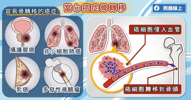 坐著看報竟骨折、癱瘓！對抗癌症骨轉移，肺癌專家圖文解析-高血鈣