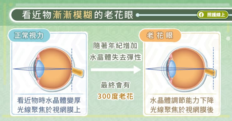 老花一定要戴眼鏡？眼科醫師曝雷射手術的優缺點與風險-水晶體
