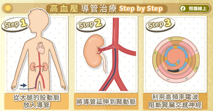 血壓高，恐爆血管、心臟病！高血壓導管治療幫助穩定血壓、減少藥物，醫師圖文解說-722原則