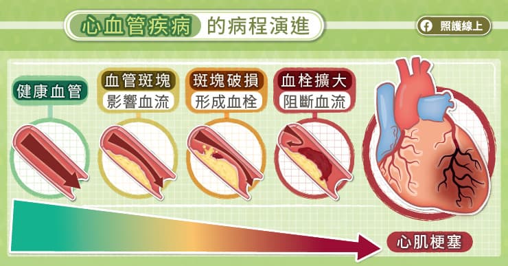 心肌梗塞容易復發，救命後要長期保養，心臟專科醫師圖解說明-心肌梗塞