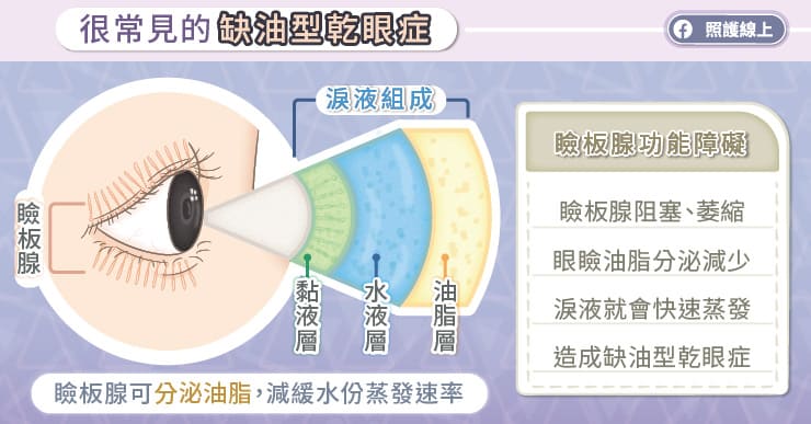 淚水缺油脂，眼睛乾澀、好疲勞，乾眼症治療保養重點，眼科醫師圖文解說-人工淚液