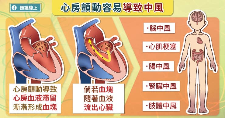 不到40歲就中風！竟是心房顫動在作祟？醫曝5大危險因子要注意-中風