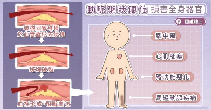 30歲男突如其來的胸痛胸悶，竟是心肌梗塞！心臟科權威洪惠風醫師：低密度膽固醇加速動脈硬化-心肌梗塞