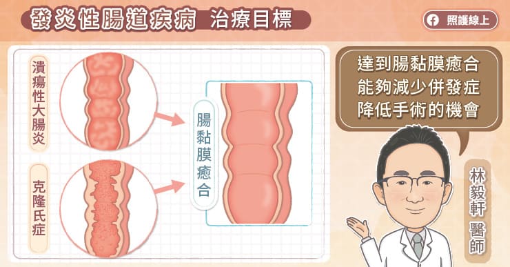 名醫專訪》治療發炎性腸道疾病，要追求腸道黏膜癒合，別讓發炎持續危害，專科醫師圖文解說-交通大學附設醫院