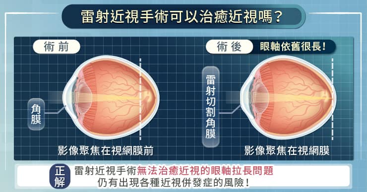 名醫專訪》「近視」是一種疾病，對眼睛很傷，還可能導致失明！-白內障
