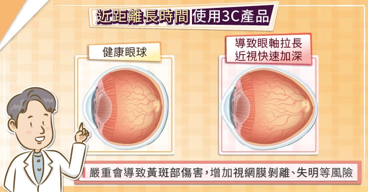使用3C要適度，避免眼睛受傷害，醫師圖解-白內障