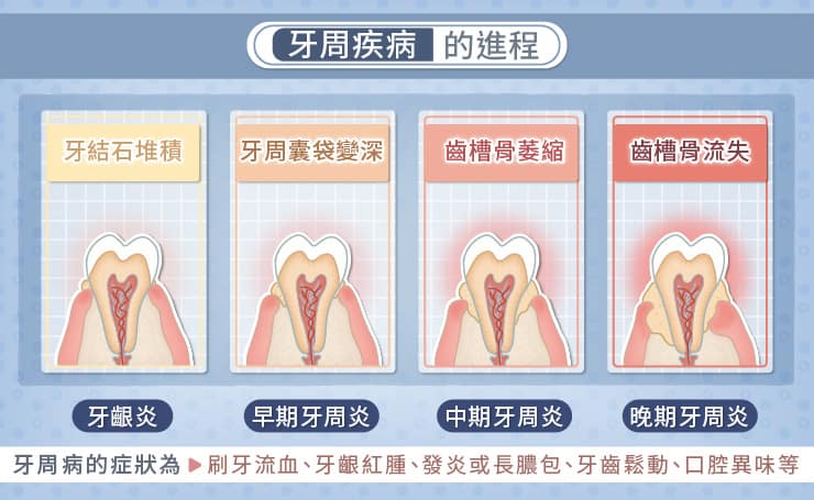 我有牙齦炎怎麼辦？圖文懶人包-牙周病