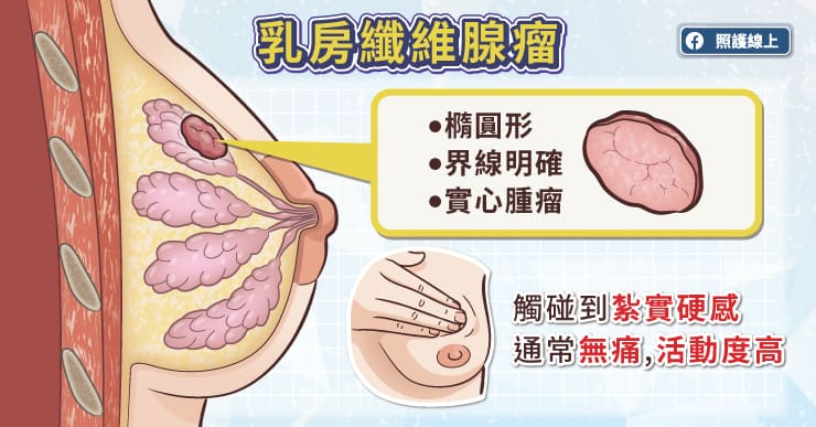 好發於年輕女性的乳房纖維腺瘤和乳癌有關嗎？有哪些症狀要注意？-女性荷爾蒙