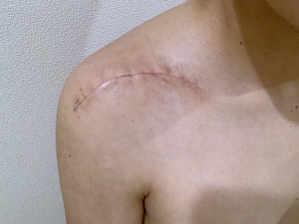 別讓傷痕「疤」著你不放  控制生物時鐘促進疤痕癒合-Npas2