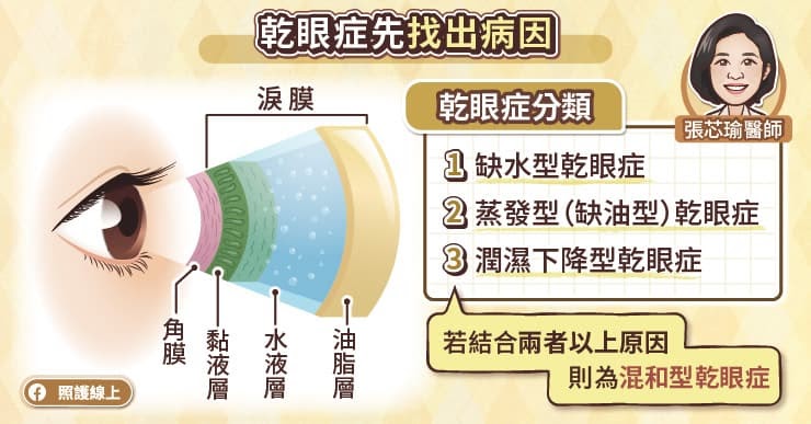 眼睛乾澀、容易疲勞，先確定乾眼症分類，才能選擇正確治療，眼科醫師圖文解說-人工淚液