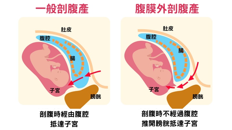 自費「腹膜外剖腹產」遭踢爆違法 衛福部：依法查辦-大出血