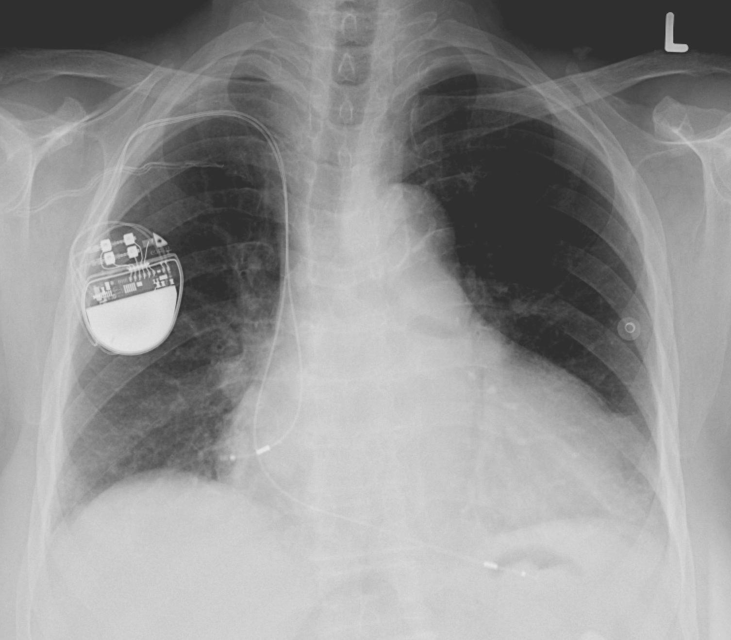 心臟也需要裝電池？有線心臟節律器將走入歷史-Pacemaker