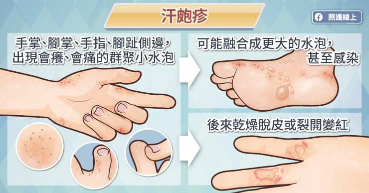 沒事就突襲手、腳的癢癢小水泡，用六招避免汗皰疹復發-小水泡