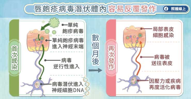 嘴唇刺痛燒灼感？小心！唇皰疹可能找上門｜嘴唇冒出痛痛小水泡，這些事情不能做（圖文懶人包）-水泡