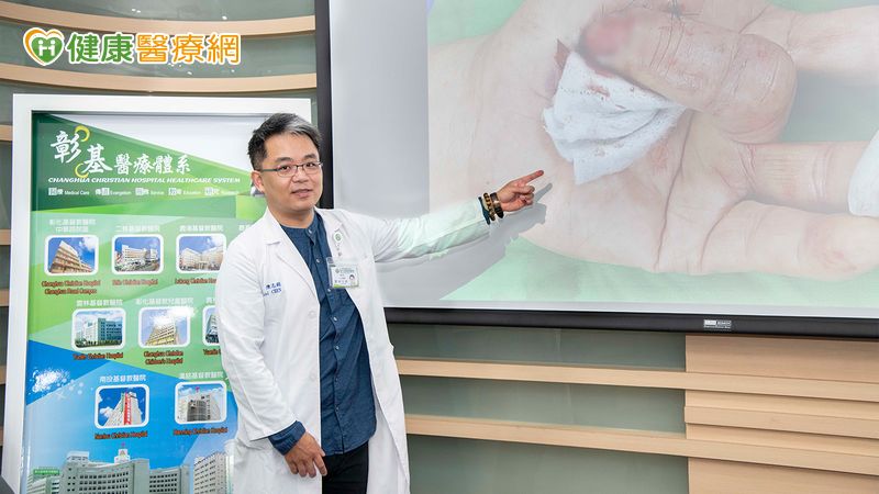 手指截斷能長回？ 「埋指養指」助斷指重生-手指截斷